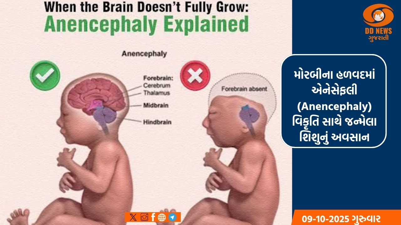 મોરબીના હળવદમાં એનેસેફલી (Anencephaly) વિકૃતિ સાથે જન્મેલા શિશુનું અવસાન